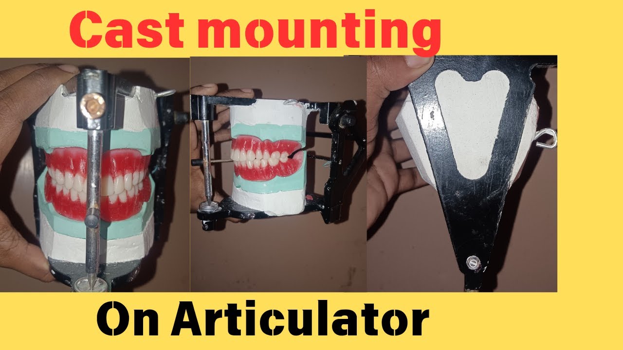 mountin Cast on Articulator | Mounting of Cast|