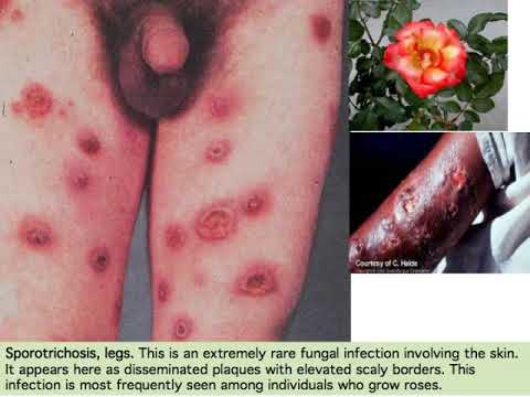 subcutaneous mycoses