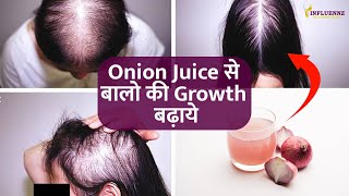 प्याज का रस बालों में लगाने के फायदे  | Onion Juice Balo Ke Liye (onion juice for hair hindi) screenshot 3