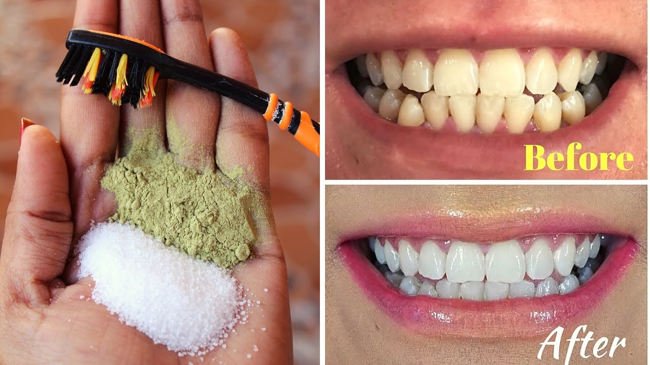 ನಿಮ್ಮ ಹಲ್ಲುಗಳು ಎಷ್ಟೇ ಹಳದಿ ಇದ್ದರು ಮುತ್ತುಗಳ ಹಾಗೆ ಹೊಳೆಯುತ್ತವೆ Teeth