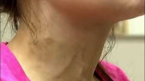 Giant C-V Waves of Tricuspid Regurgitation | NEJM