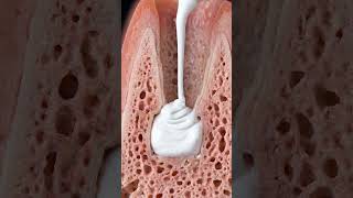 The "Backdoor Save" – Retrograde Root Seal (Apicoectomy) #dentist #tooth #dentalartistry #dentistry