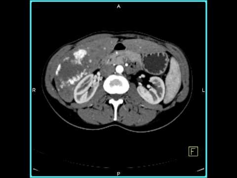 Abdomen: Liver: Cavernous Hemangioma of the Liver(1 of 9)