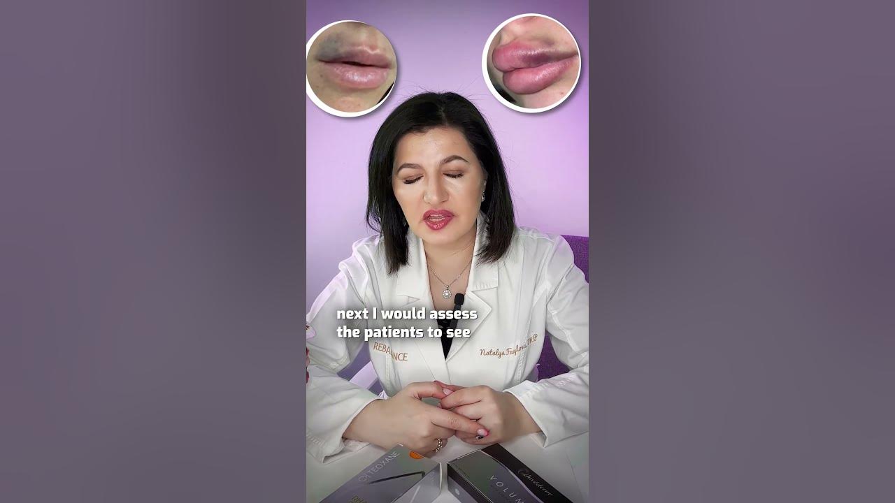 bruising-after-filler-injection-what-should-you-do-youtube