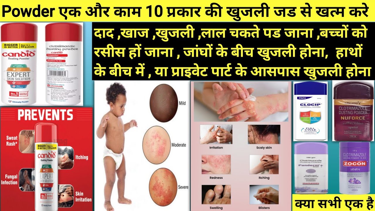 Candid powder || Candid powder for baby rashes || Candid powder for fungal infection
