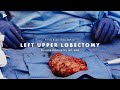 .assisted thorascopic left upper lobectomy by shanda blackmon md  preview