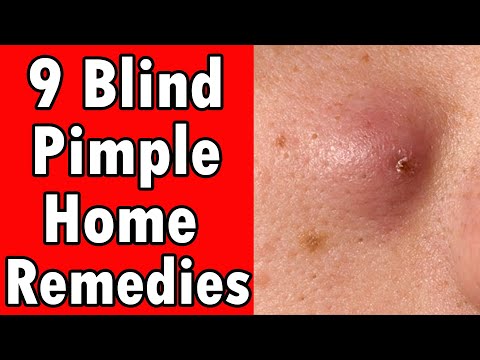 9 Home Remedies For A Blind Pimple