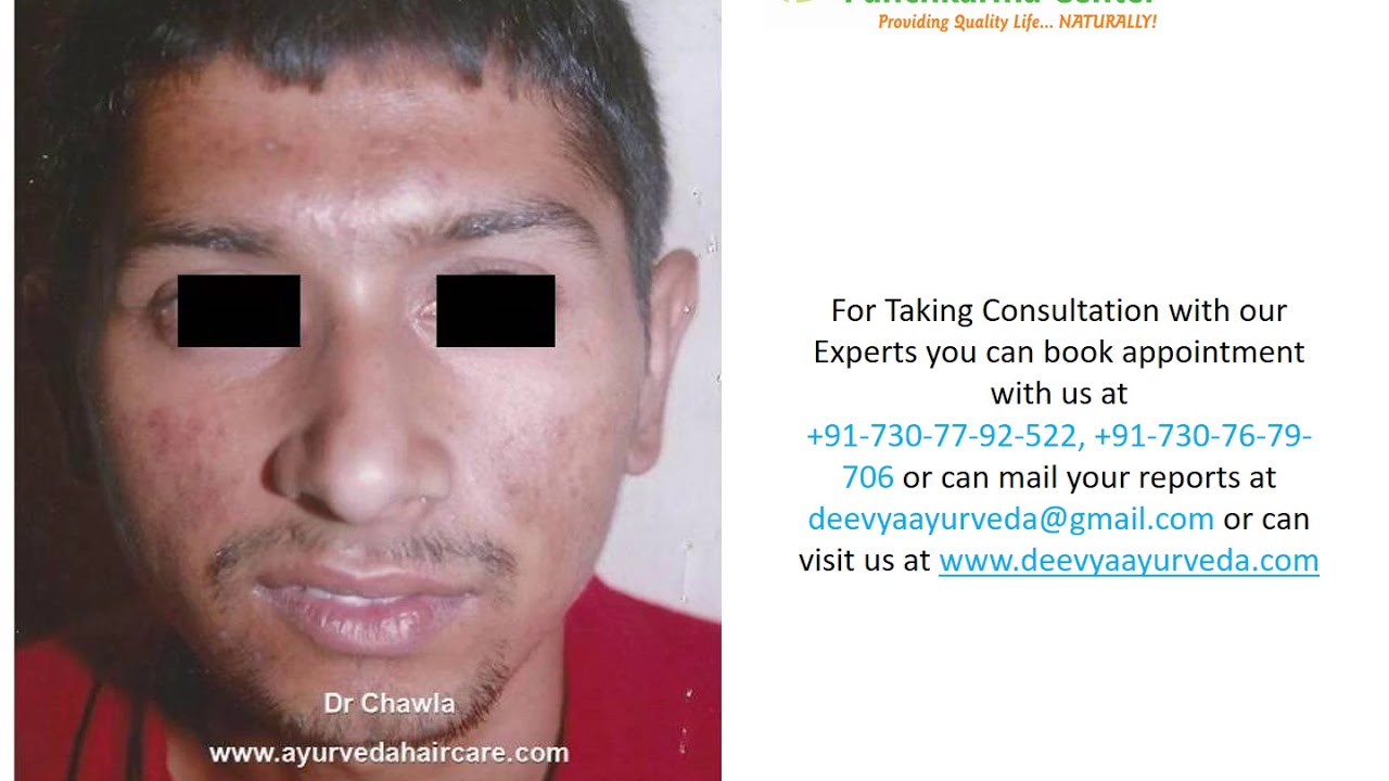 ACNE / ROSACEA /CORN / MOLES / PIMPLES /CYSTIC ACNE / BLEMISHES