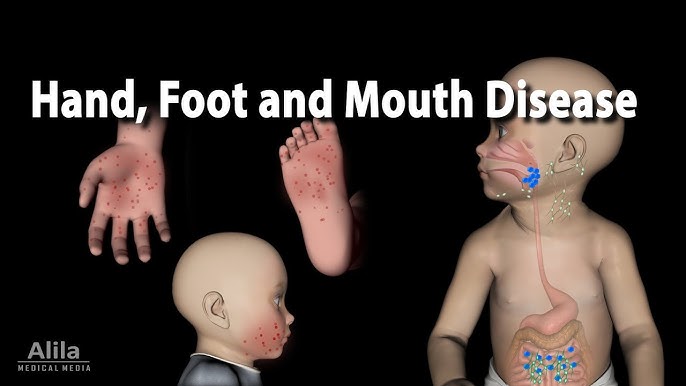 Infectious Mononucleosis (Mono) - the Kissing Disease, Animation 