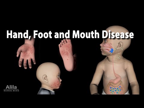 Hand Foot and Mouth Disease, Animation