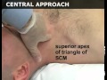 Jugular Central Venous Catheterization   Step by step