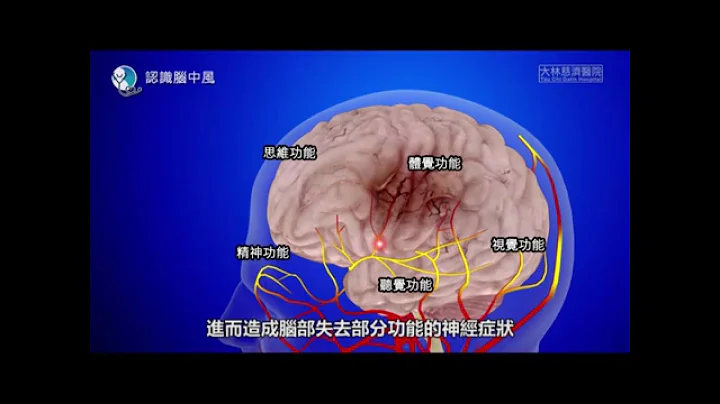 【科普教育】认识脑中风 - 天天要闻