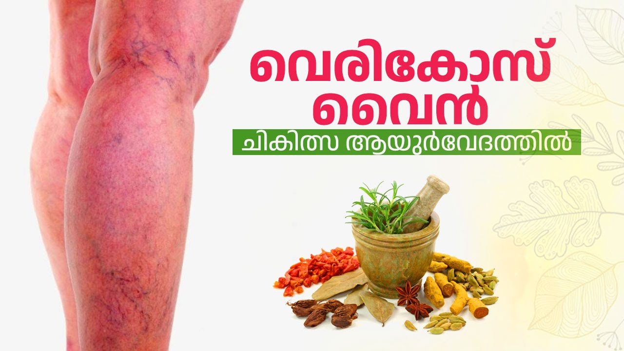 ആർക്കെല്ലാം വെരികോസ് വൈൻ രോഗം വരാം | Varicose Vein | Vascular Health | Varicosity | Health