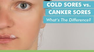 Cold Sores vs. Canker Sores: What's The Difference?