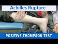 How to Perform a Thompson Test on a Patient with a COMPLETE ACHILLES RUPTURE!