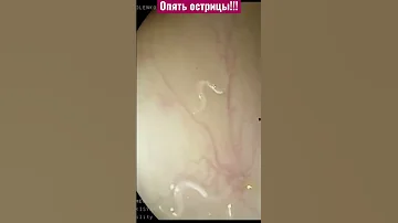 Это глисты острицы безнаказанно гуляют по нашей кишке. А хозяйка девушка 30 лет, любительница рыбы