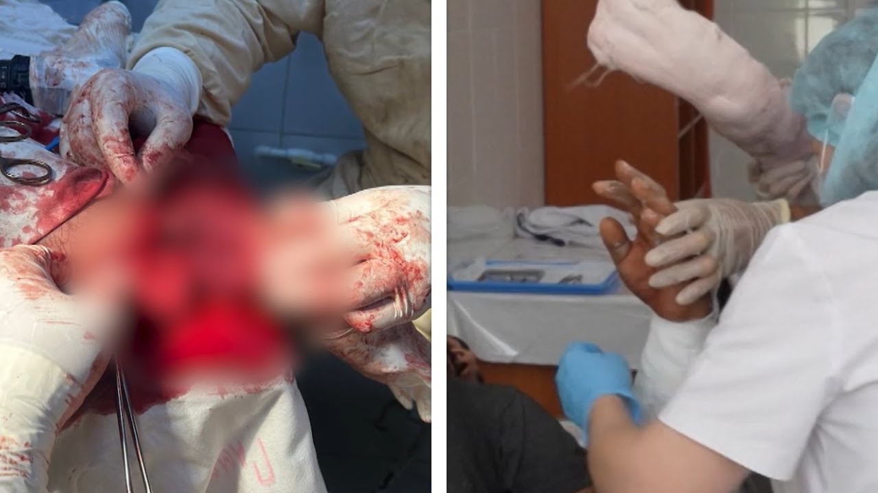 Хирурги пришили отрезанную руку рабочему в Дагестане