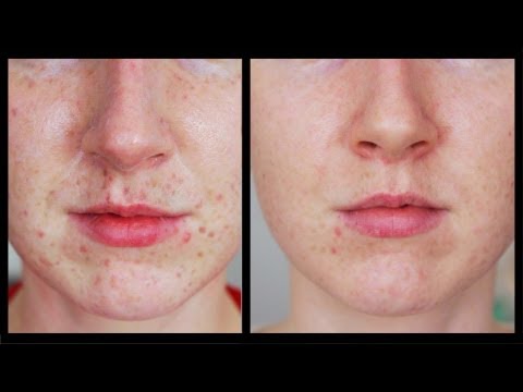 12 Home Remedies To Get Rid Of Freckle On Face