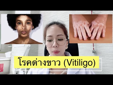 วีดีโอ: วิธีการวินิจฉัย Vitiligo: 14 ขั้นตอน (พร้อมรูปภาพ)