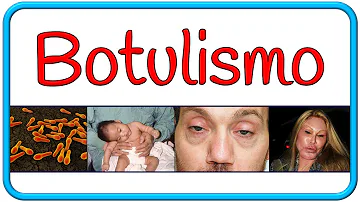 ¿Cuáles son los 4 síntomas del botulismo?