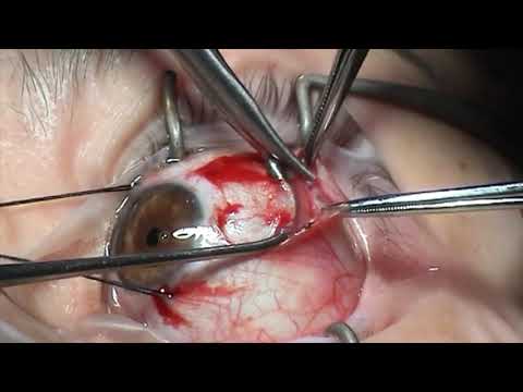 Simulated Surgery: Strabismus Surgery: Resection Techniques