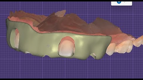 How to design gingivectomy guide in exocad easy, fast and cheap