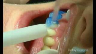 GlamSmile Porcelain Veneers on Today Tonight | Affordable Porcelain Veneers