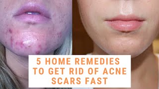 5 home remedies to get rid of acne scars fast