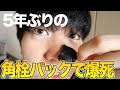 角栓動画で100万再生した男が4年越しのリベンジに..! 微細カメラも加えて毛穴の隅々まで観察した！