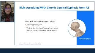 Clinical Considerations for Airway Management in Patients with Ankylosing Spondylitis