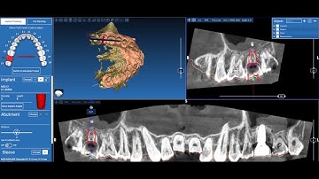 TIP 2: Lập kế hoạch Implant 