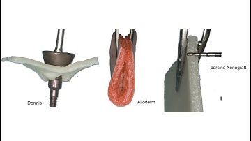 Tomas Linkevicius - 5. Vertical soft tissue augmentation with soft tissue grafts