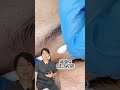 瞼からニュルニュル出てくる稗粒腫除去!#shorts #acne #acneremoval