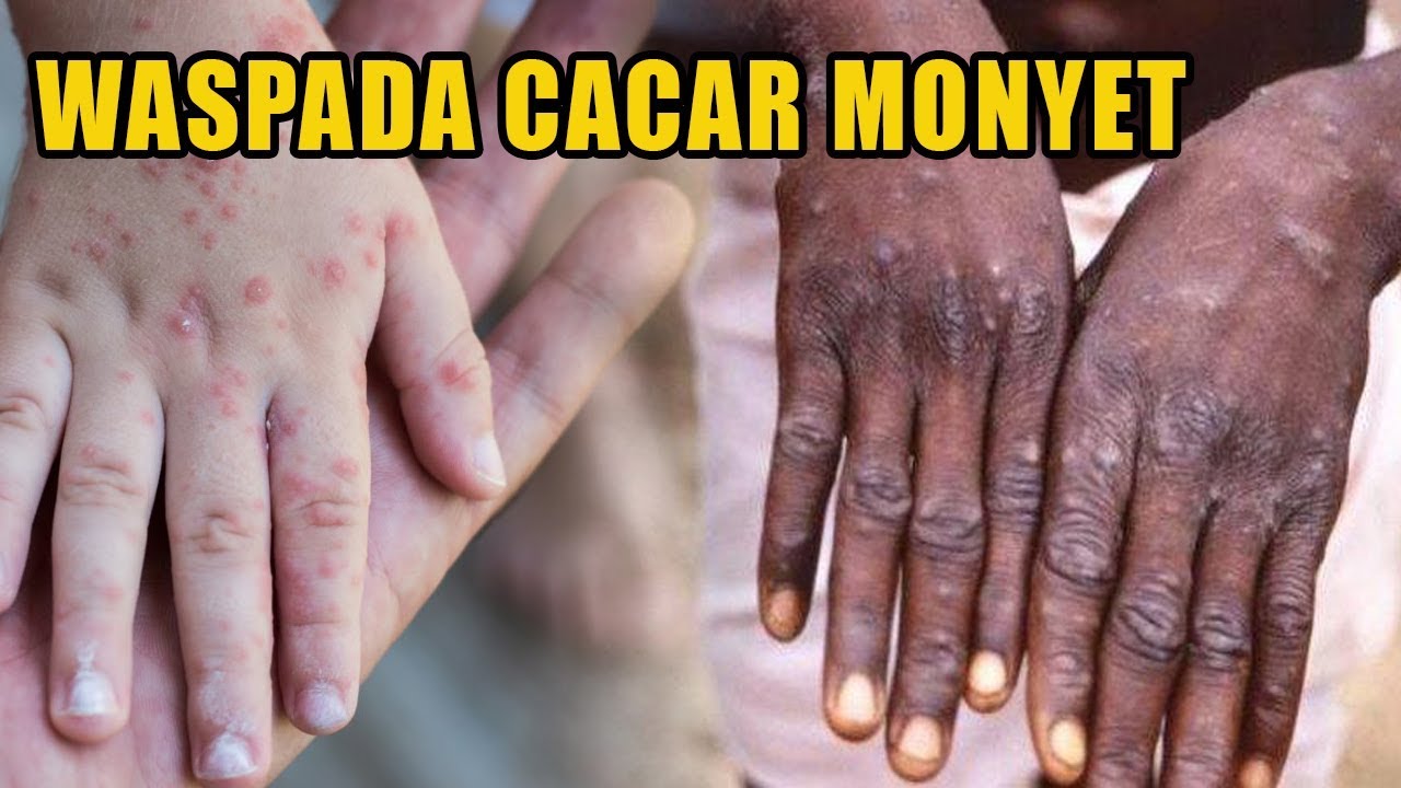 Cara Mengobati Cacar Monyet Fakta Penyakit Cacar Monyet yang Menghebohkan Singapura - YouTube