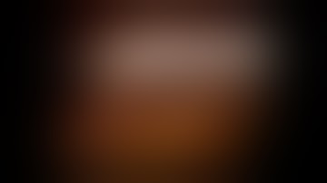 Robot Assisted Pyeloplasty & Pyelolithotomy