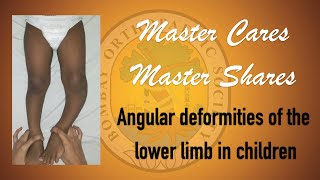 Master Shares Master Cares - Angular deformities of lower limb in children