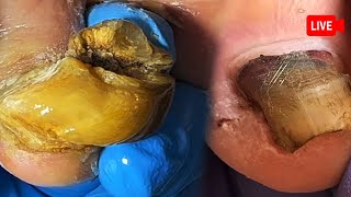 [ Live Streaming ] Ingrown Toe nail | Pedicure | Onychomycosis Foot | Podiatrist Treatment Live