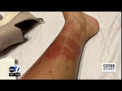 Naples woman gets bacterial infection from water at Tigertail Beach