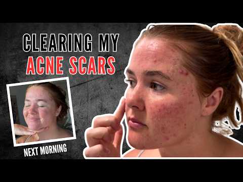 How I Cleared 99% of My Acne Scars at Home - video from Banish