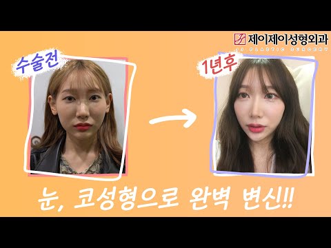눈성형, <strong>코성형</strong> 전후 영상 - 제이제이성형외과 #shorts