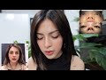 BIGGEST REGRET IN MY LIFE? (Rhinoplasty Journey Pt.2) | Mika Salamanca