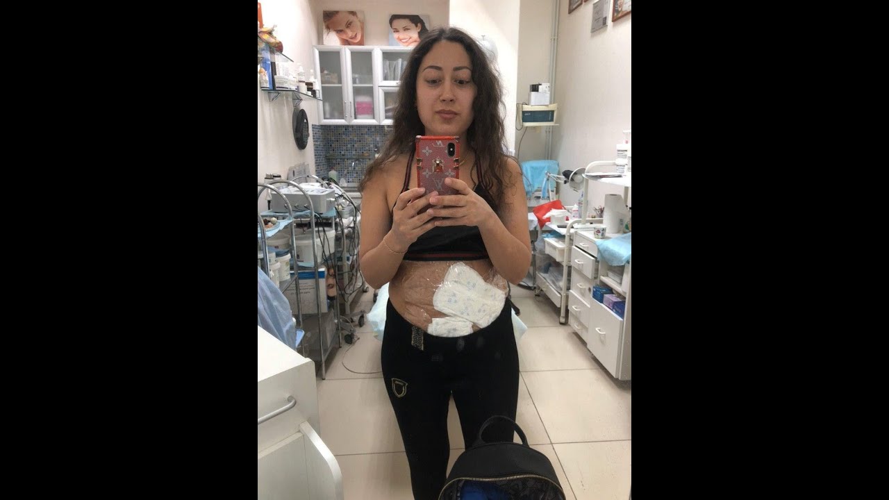 ГИРУДОТЕРАПИЯ ПРИ БОЛЕЗНИ ГРЕЙВСА/МОЙ ОПЫТ/ПИЯВКИ/ЛЕЧЕНИЕ ПИЯВКАМИ ...