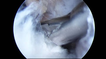 Suprascapular Nerve Decompression Case - Part 4