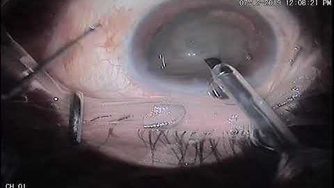 Tilt and tumble for soft cataract phacoemulsification