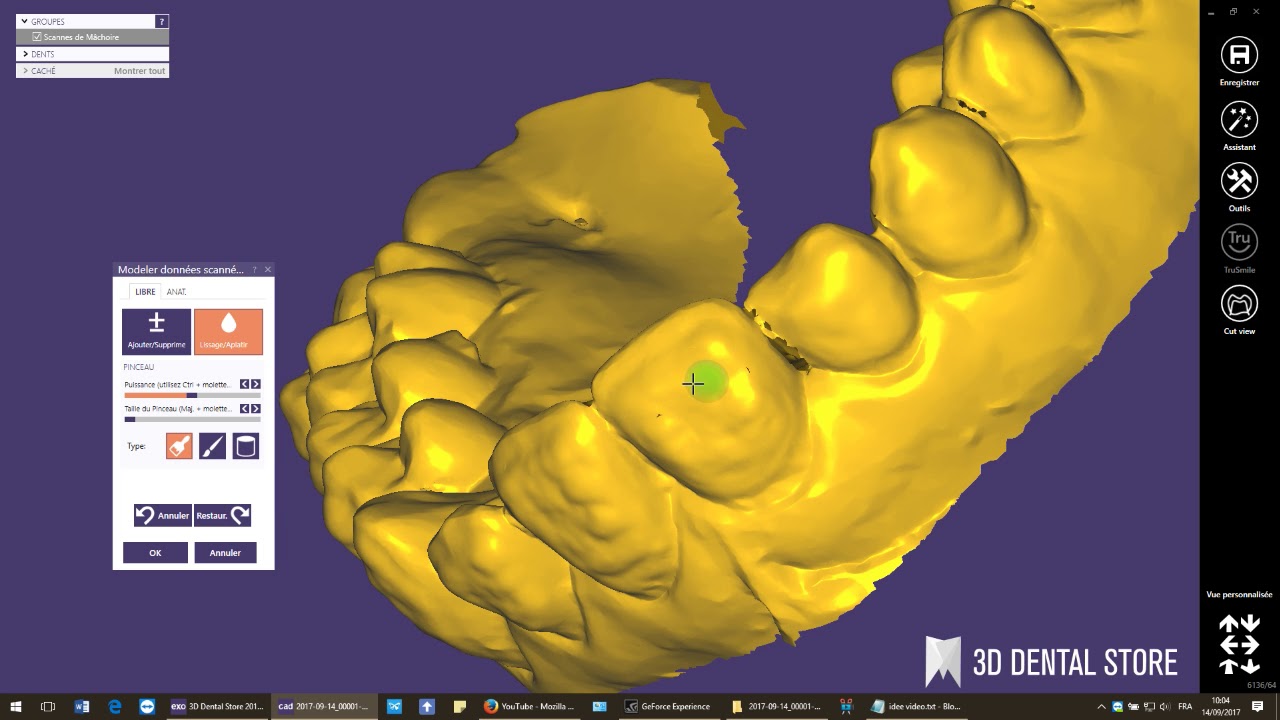 exocad : Gouttière de blanchiment