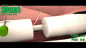 ¿Cómo suturan un tendón?