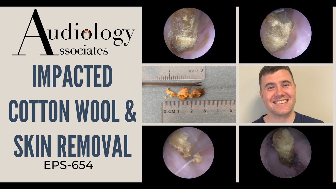 IMPACTED COTTON WOOL & SKIN REMOVAL EP654 YouTube