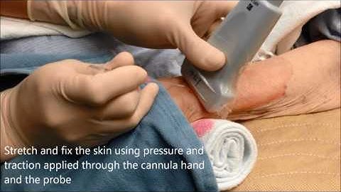 Essential guide to ultrasound-guided arterial line insertion