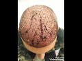 مراحل نمو زراعة الشعر بعد الزراعه 