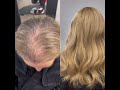 #nonsurgicalhairreplacement #hairlosssolution #hairreplacement #hairlossspecialist